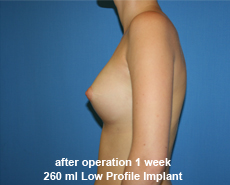 plastic-surgery-breast-augmentation